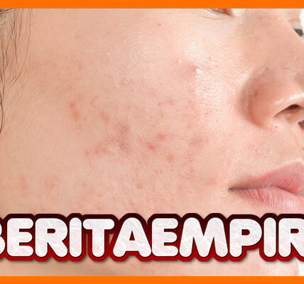 Kenali 4 Jenis Jerawat Membandel dan Tips Menghilangkannya