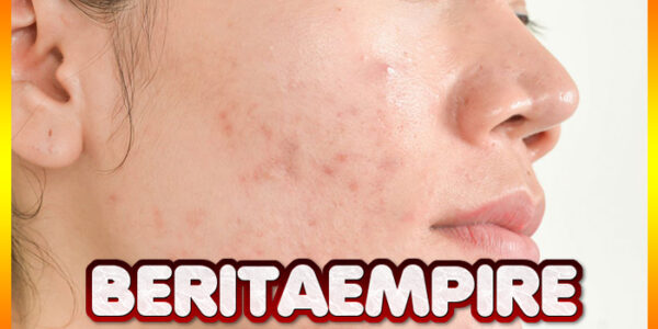 Kenali 4 Jenis Jerawat Membandel dan Tips Menghilangkannya