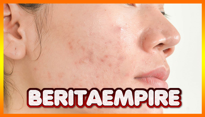 Kenali 4 Jenis Jerawat Membandel dan Tips Menghilangkannya