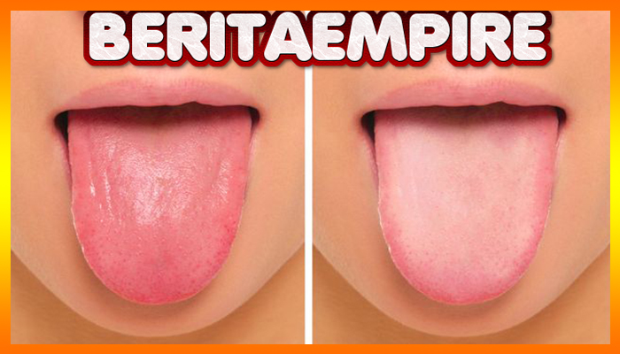 Warna Pada Lidah Bisa Cerminkan Kesehatan Pada Tubuh